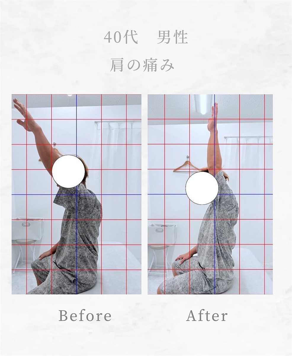 40代男性の肩の痛みのビフォーアフター。施術後は腕を耳の横まで上げられるようになっている